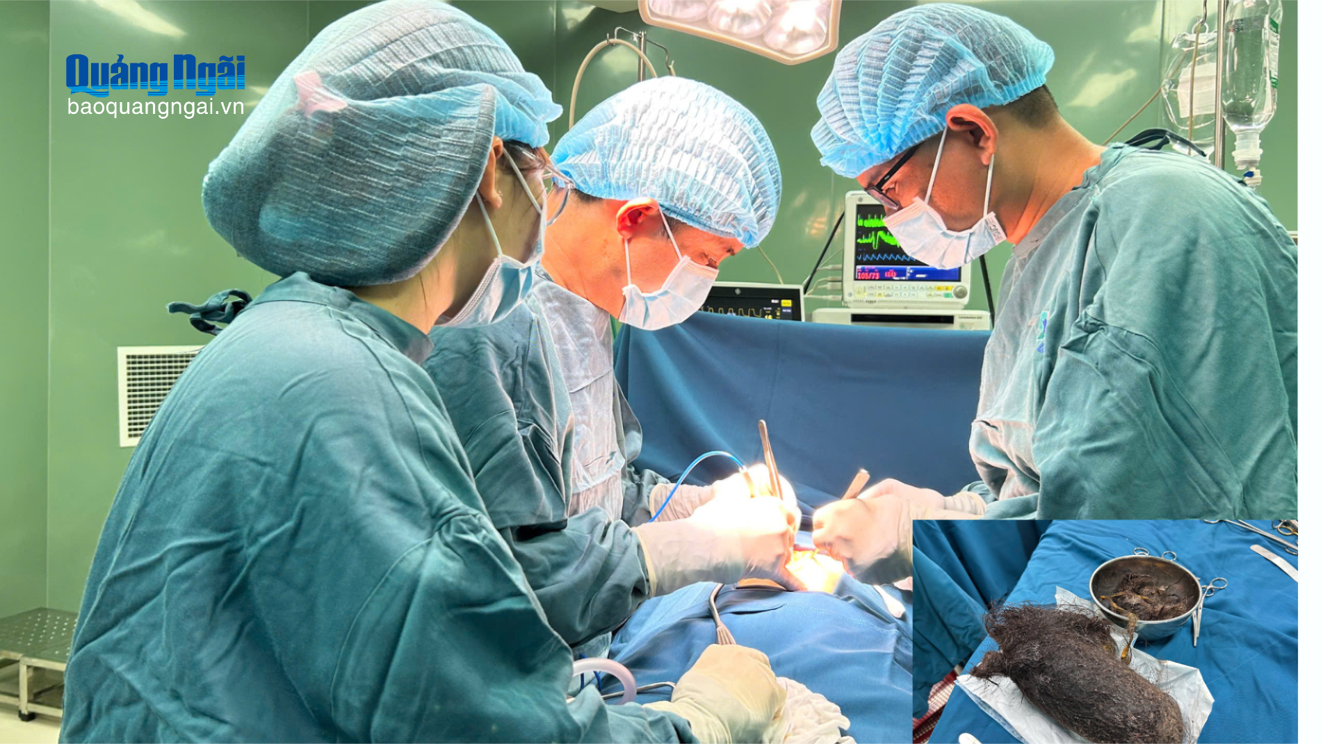 Cảnh báo hội chứng trẻ “nghiện” ăn tóc