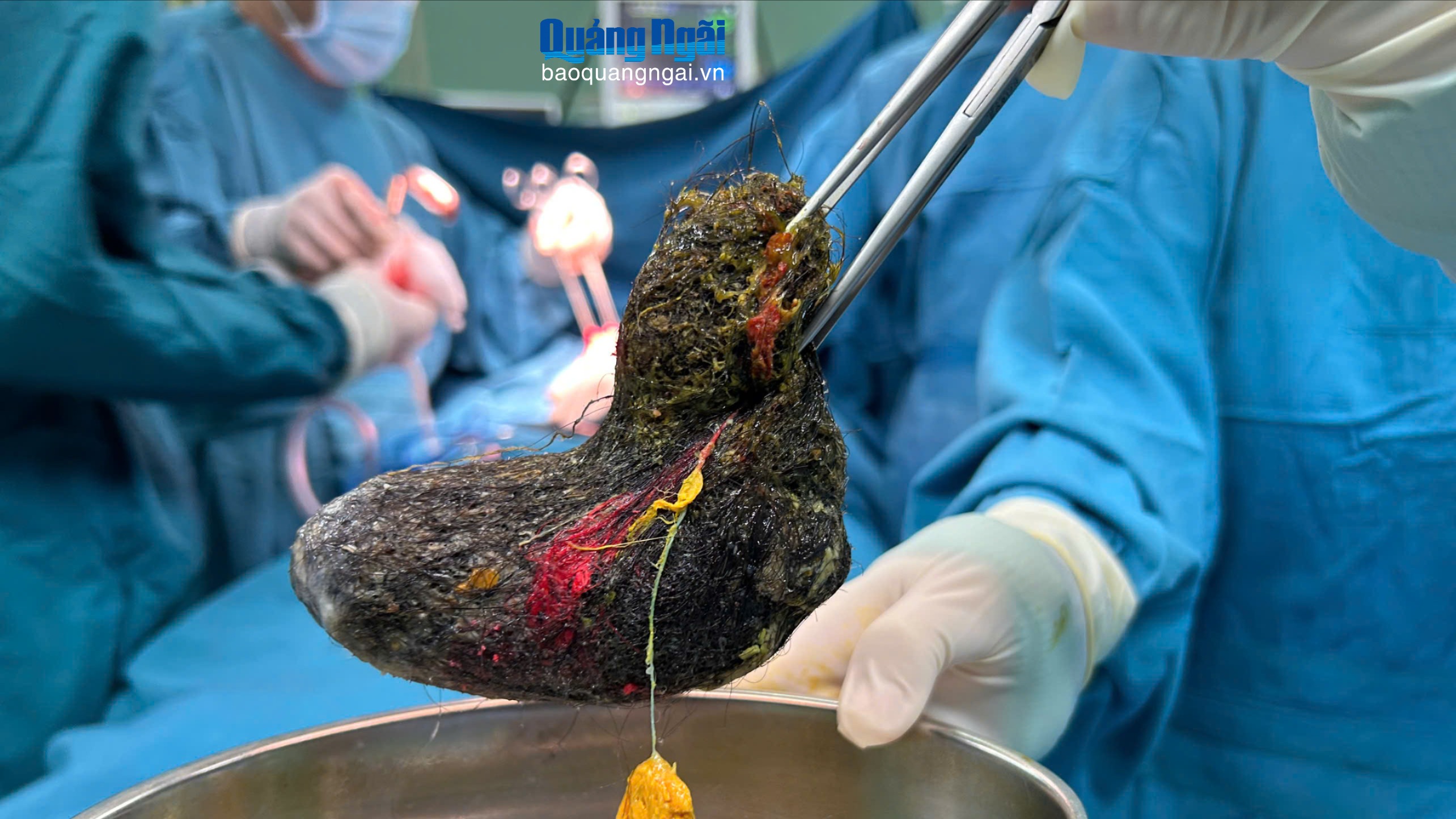 Phẫu thuật lấy dị vật búi tóc trong dạ dày bệnh nhi 7 tuổi