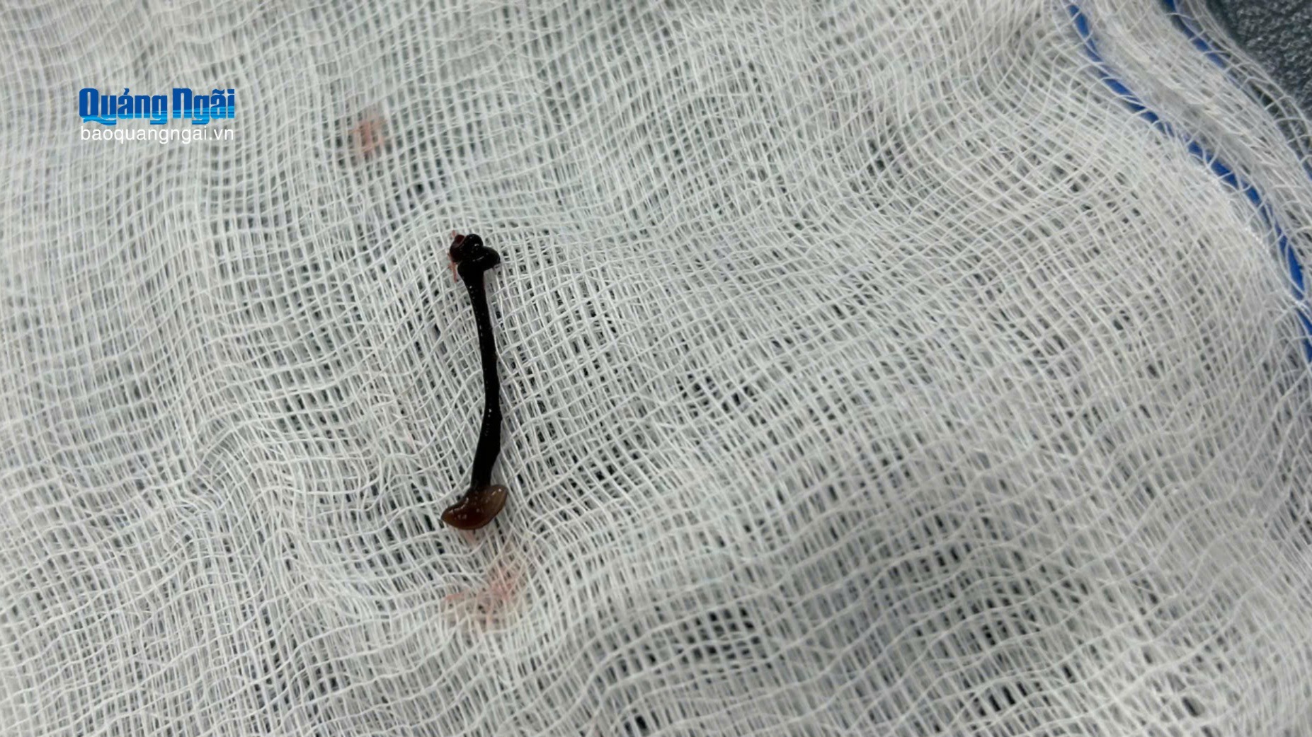 Con vắt sống một tuần trong mũi em bé 30 tháng