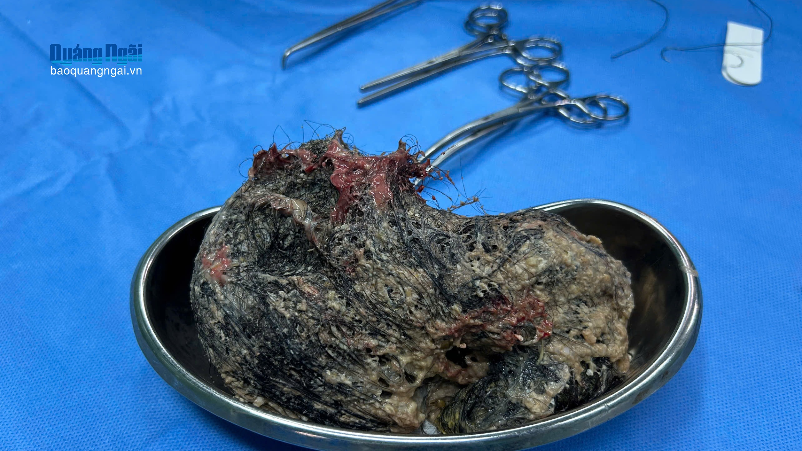 Búi tóc nửa ký trong dạ dày bé gái 6 tuổi