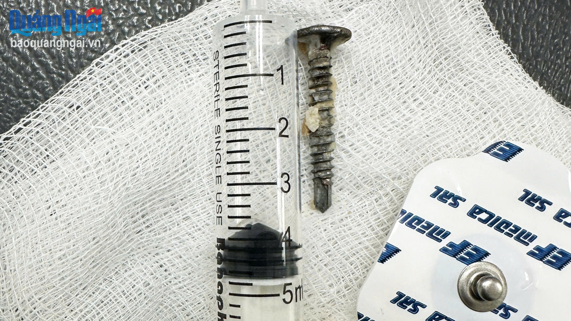 Đinh vít dài 3cm trong dạ dày trẻ 29 tháng tuổi