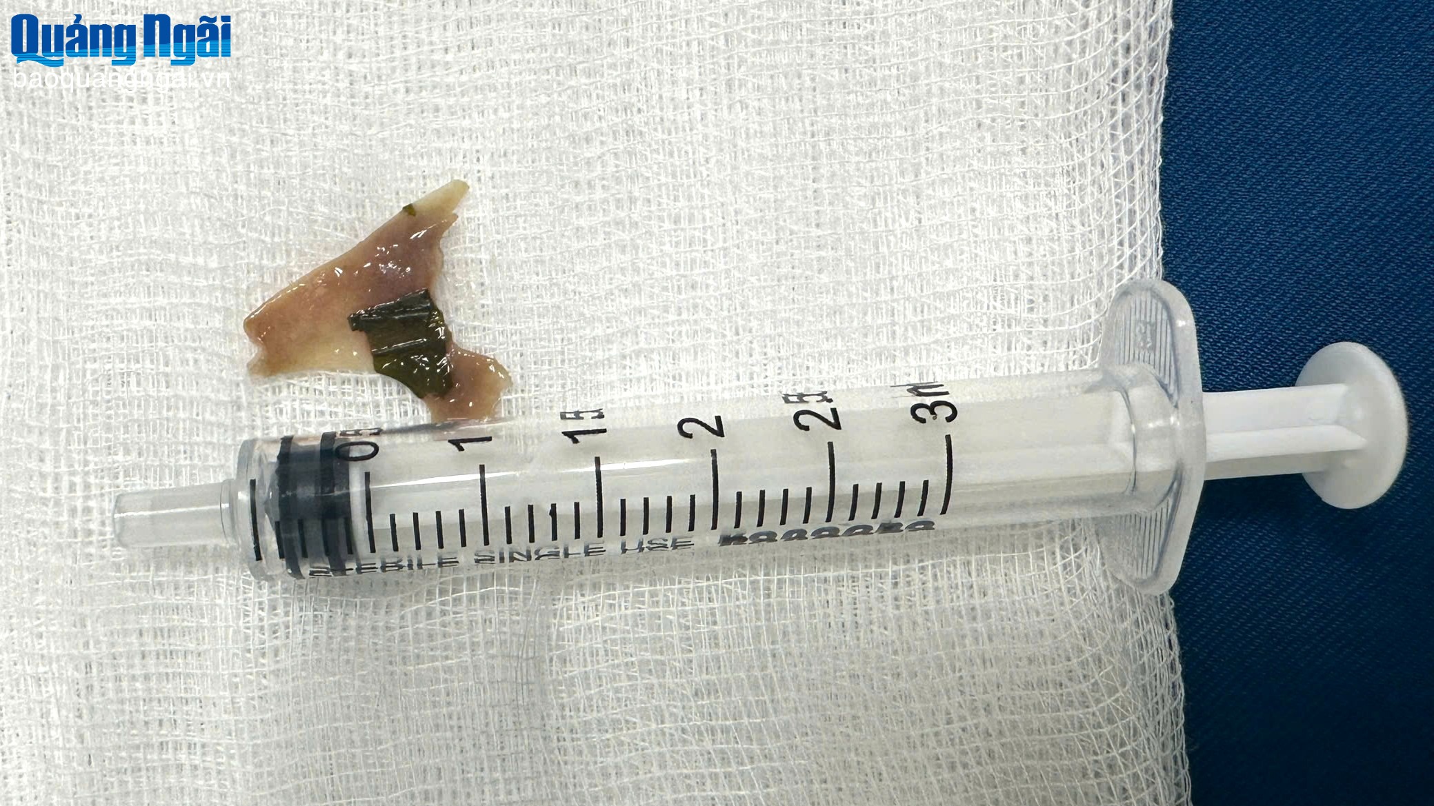 Xương vịt dài 2cm trong cổ họng trẻ 12 tuổi