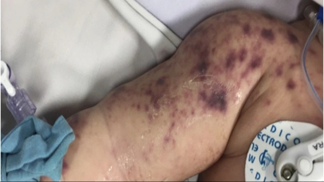 Đã có 4 ca tử vong do não mô cầu, cần biết 4 khuyến cáo phòng bệnh của Bộ Y tế