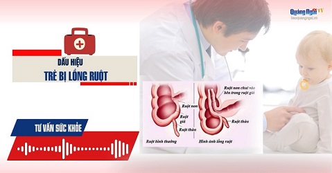 Podcast Tư vấn sức khỏe: Dấu hiệu trẻ bị lồng ruột