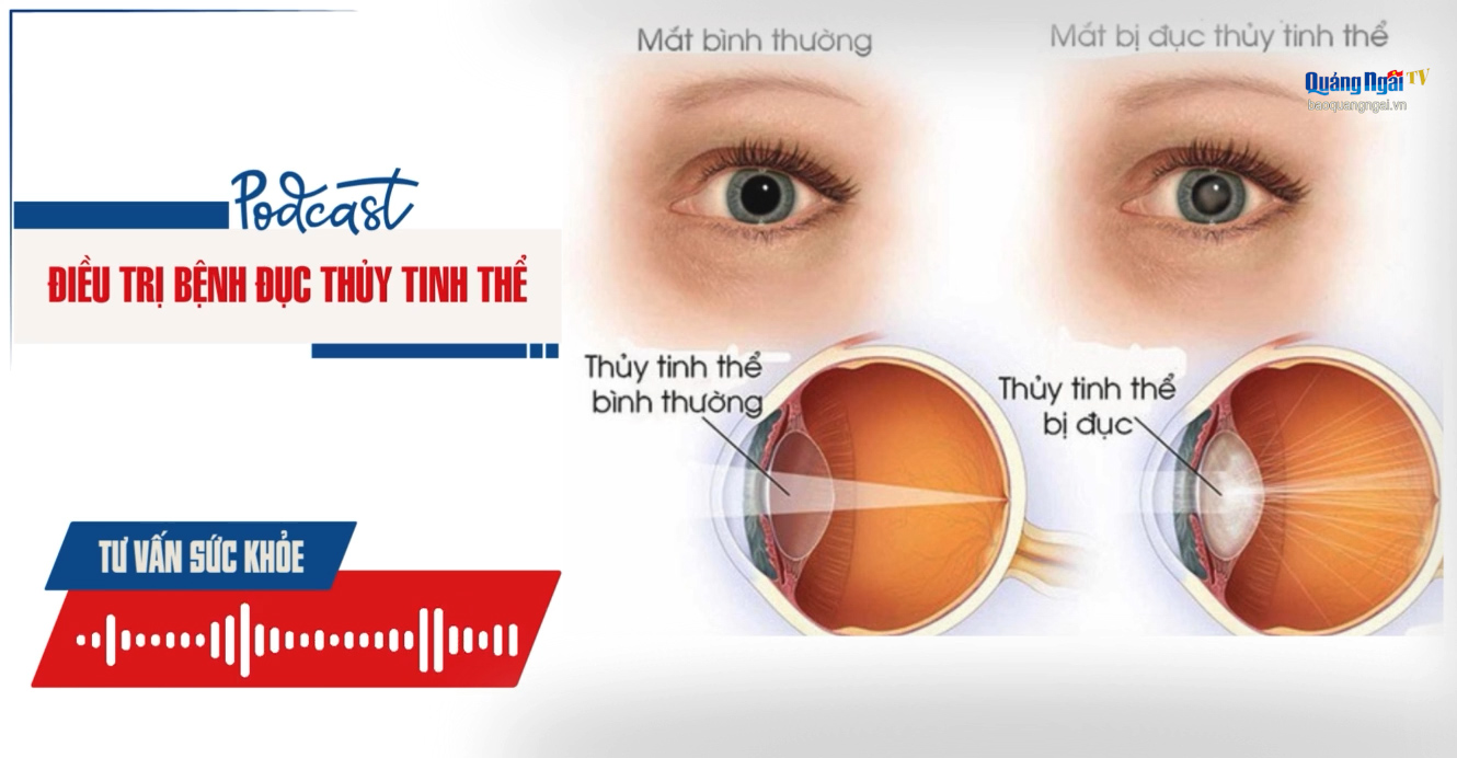 Podcast Tư vấn sức khỏe: Điều trị bệnh đục thủy tinh thể
