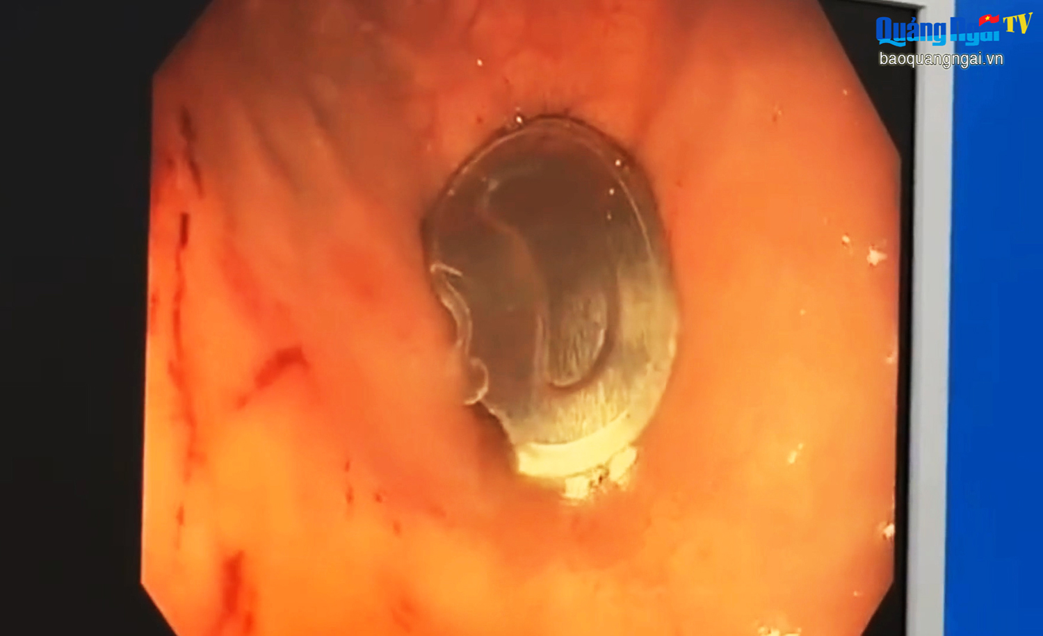 Gắp nắp lon nước ngọt trong dạ dày bé trai 11 tuổi