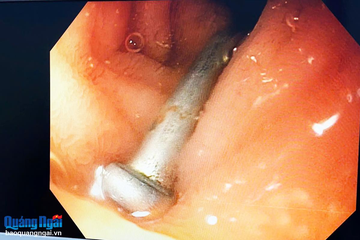 Cây đinh trong tá tràng bé trai 6 tuổi
