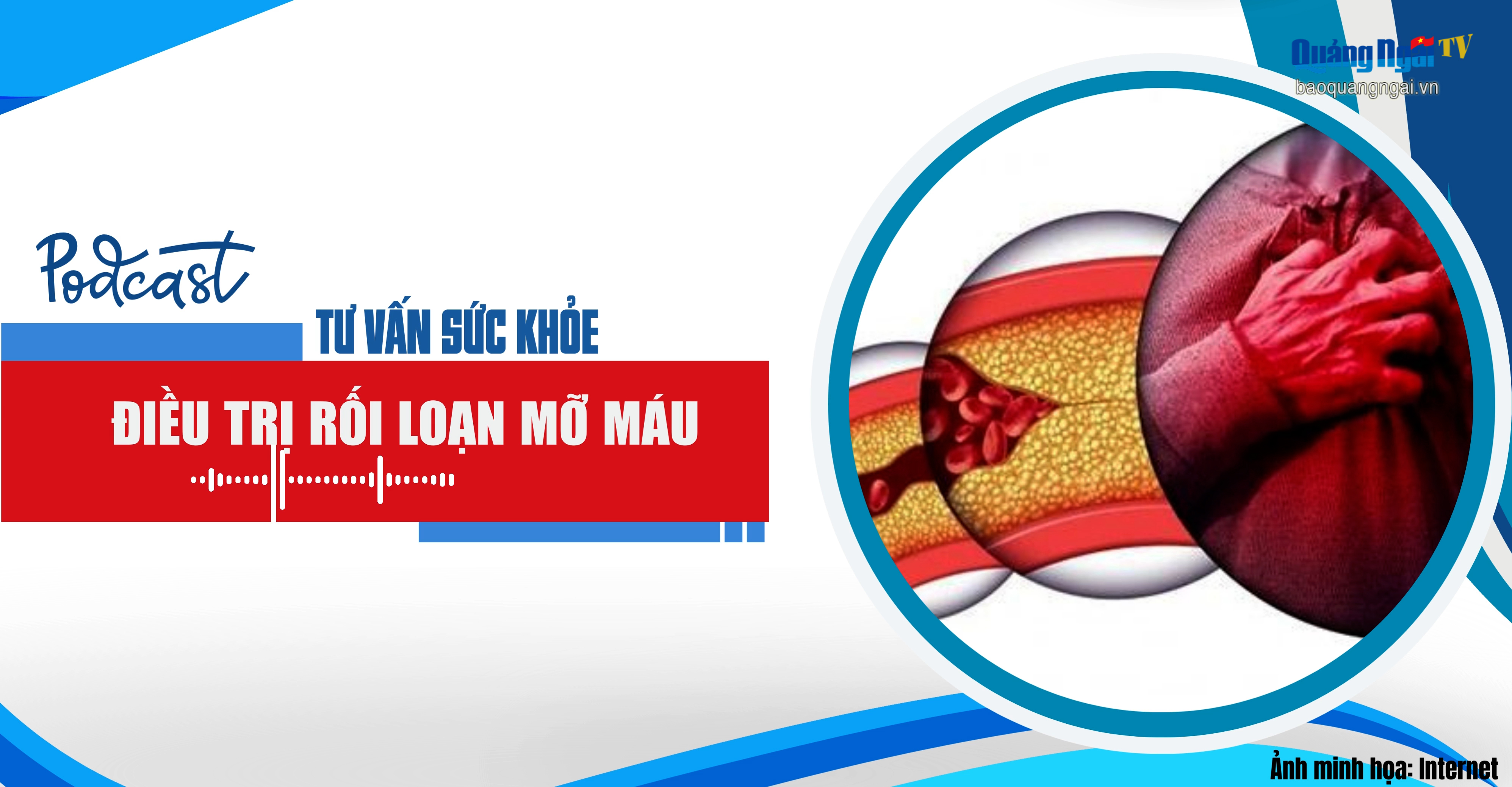 [Podcast]. Cách nhận biết và điều trị rối loạn mỡ máu