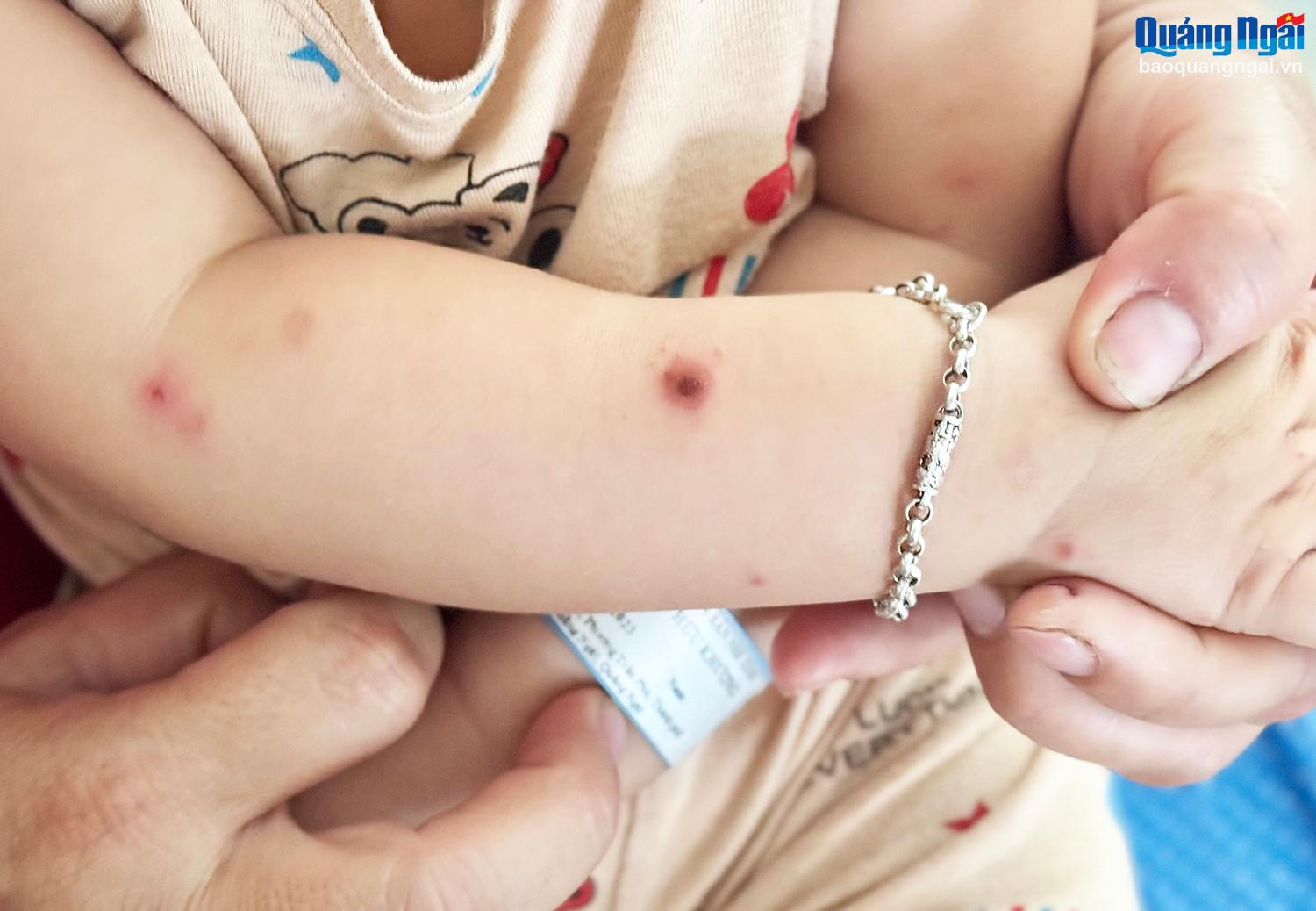 Số trẻ mắc bệnh tay chân miệng tăng cao