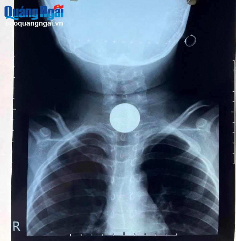 Bé 7 tuổi nuốt đồng xu phải cấp cứu