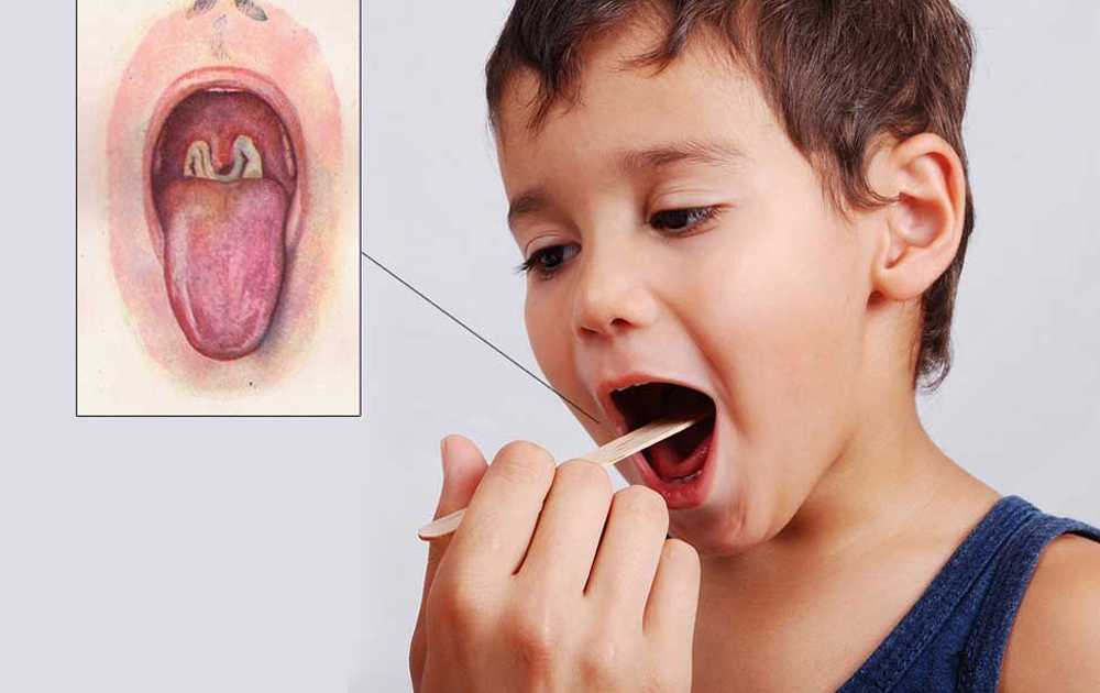 Thuốc điều trị bệnh bạch hầu thanh quản