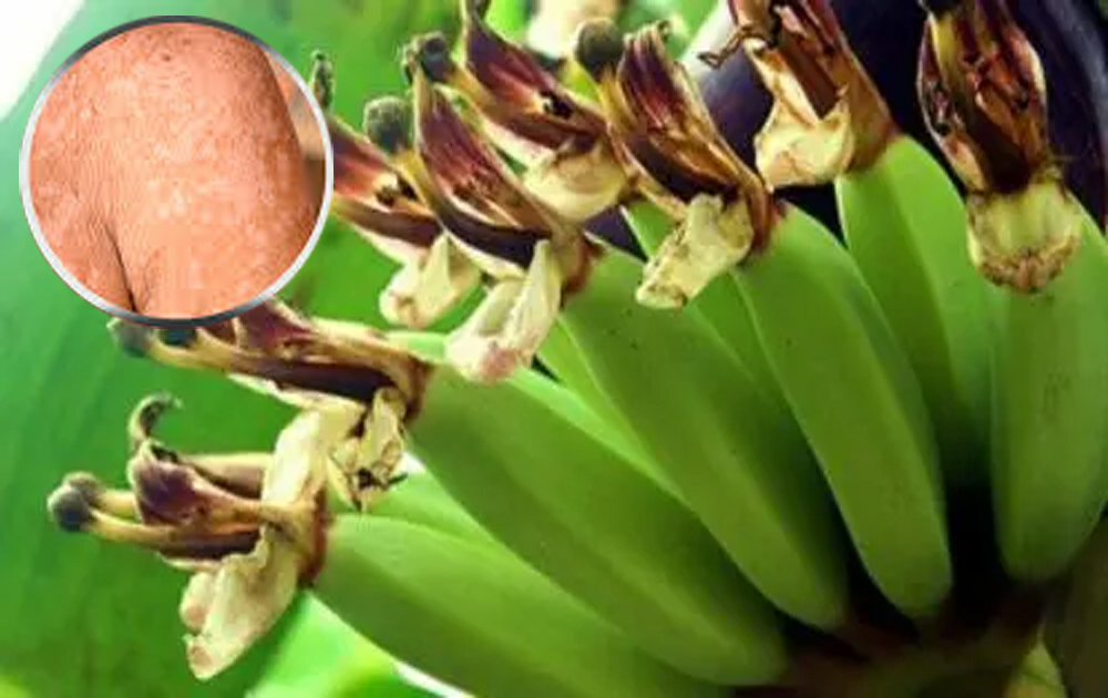 2 bài thuốc dân gian chữa lang ben hiệu quả bất ngờ