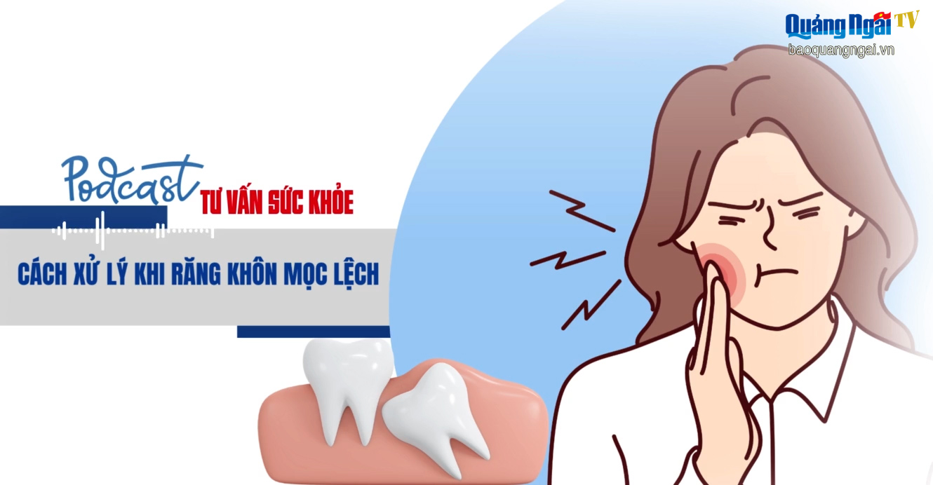 [Podcast]. Cách xử lý khi răng khôn mọc lệch