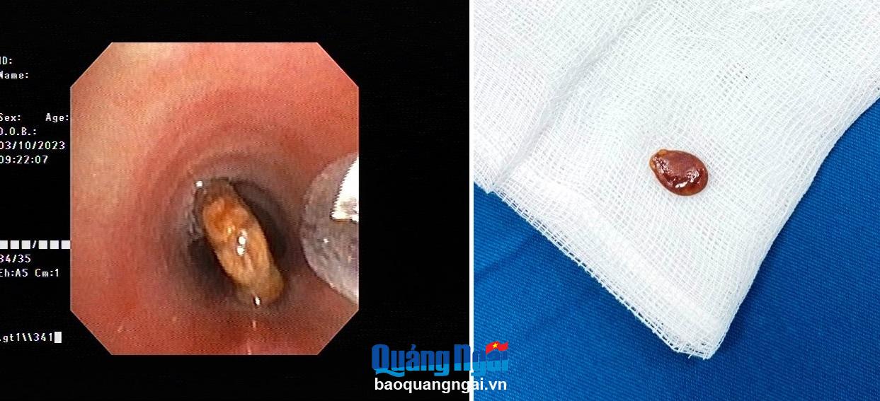 Cứu sống bệnh nhi bị mắc hạt dưa trong khí quản