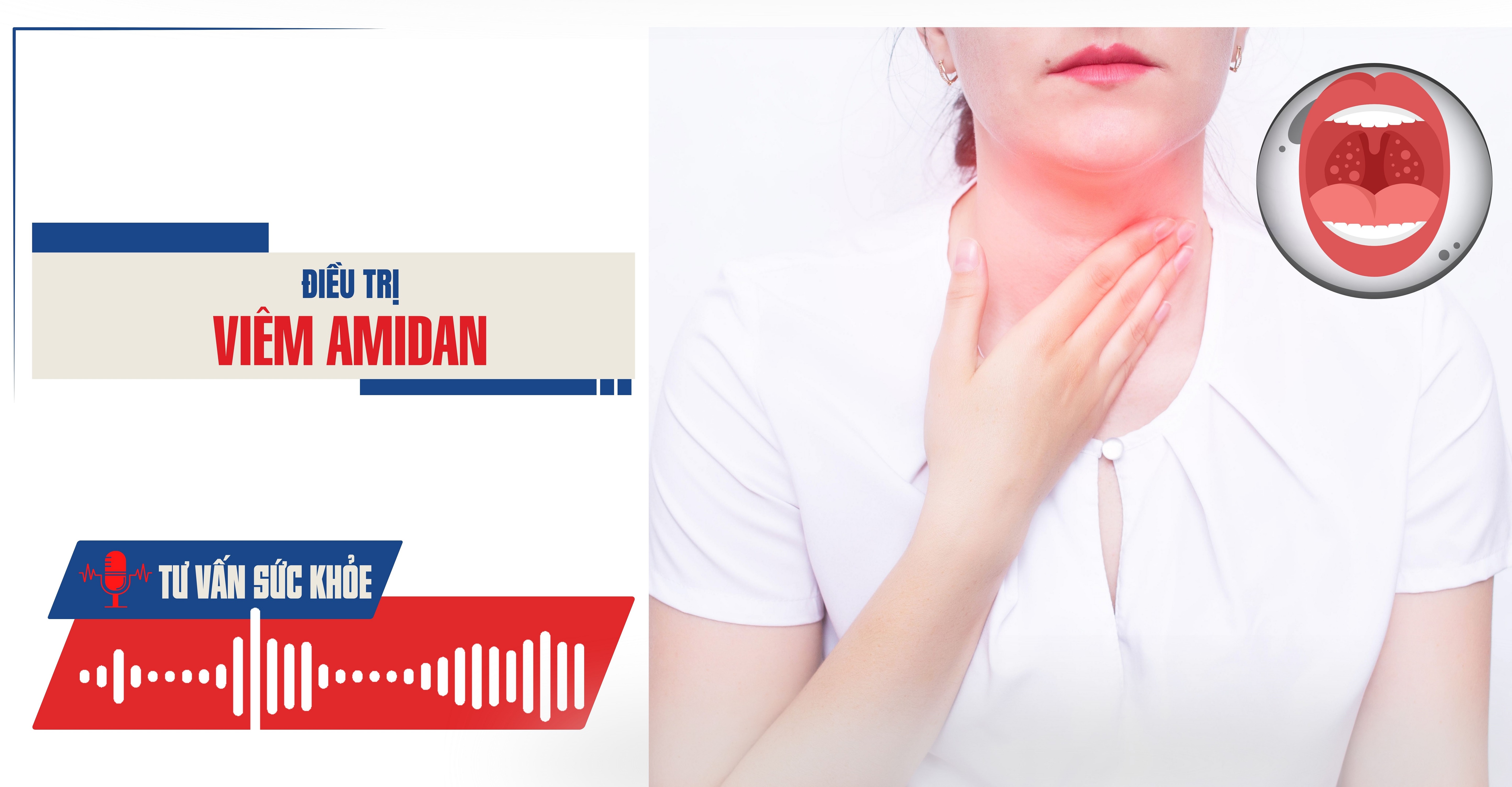 Podcast Tư vấn sức khỏe: Điều trị viêm amidan
