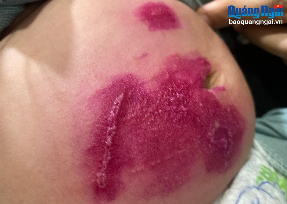 Cẩn thận với kiến ba khoang